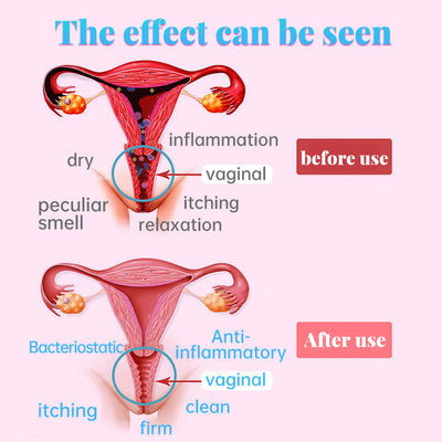 Produits de soins vaginaux pour la santé des femmes Restreindre le vagin